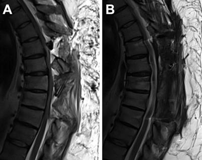 Case Report: Multilevel Ossification of the Ligamentum Flavum in a Patient With Spinal Osteoblastoma